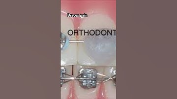 Braces pain, or BRACES PAIN||Olivia Loren the makeup princess