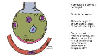 Acute Respiratory Distress Syndrome (ARDS)