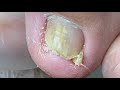 Curved nail “stabs” into toe! Carefully remove it