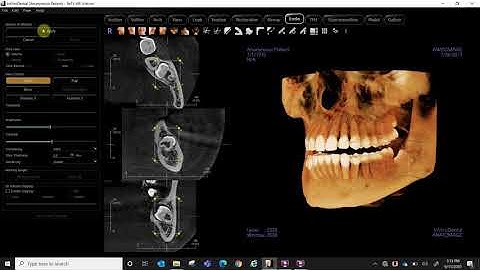 Invivo 6 Endo Tab on 3rd Molar