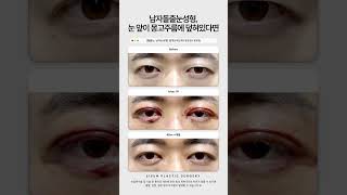 남자돌출눈성형, 눈 앞이 몽고주름에 덮혀있다면 #시선성형외과 #shorts