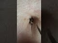 Belly Button Blackhead (Umbolith or Navel Stone) Removal