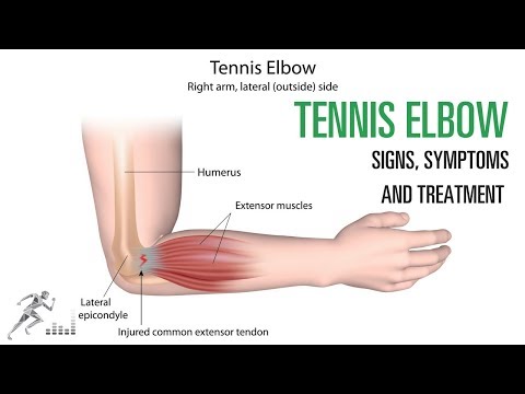 టెన్నిస్ ఎల్బో: సాధారణ మోచేయి గాయం యొక్క సంకేతాలు మరియు లక్షణాలు మరియు చికిత్స
