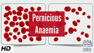 Pernicious Anemia, Causes, Signs and Symptoms, Diagnosis and Treatment.