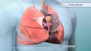 Managing Lung Cancer