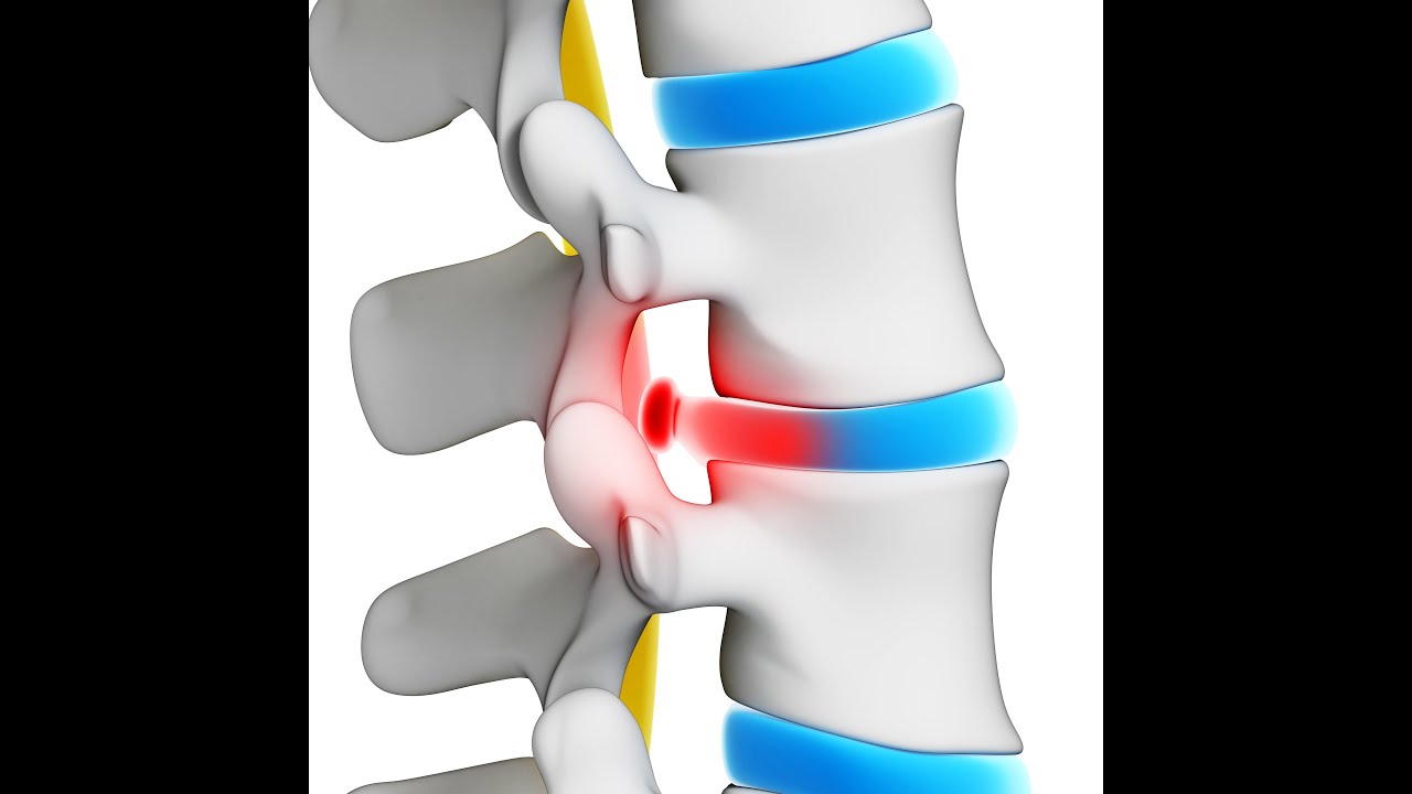 Можно ли греть грыжу поясничного. Грыжа межпозвоночного диска. Lumbar Disc Herniation. Диски позвоночника.