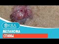 😨 Меланома спины. Клинический случай №771