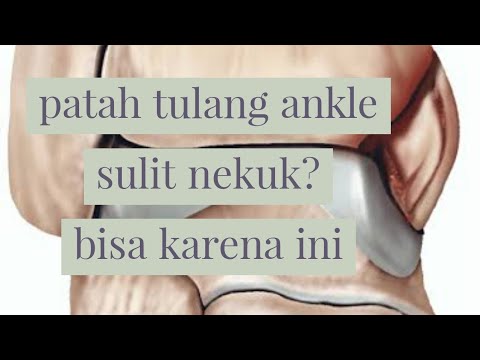 Video: Cara Mengatasi Kaki Dengan Patah Pergelangan Kaki