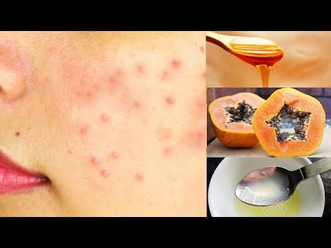 How To Get Rid of Small Pimples On Forehead Fast