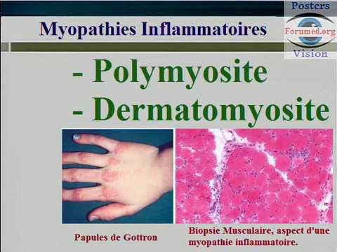 Les Myopathies inflammatoires : Polymyosite et Dermatomyosite Faiblesse musculaire