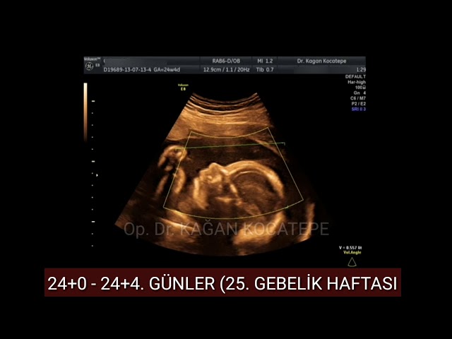 24 haftalik 5 5 aylik gebelikte kiz bebek nasil gorunur renkli doppler 4 boyutlu detayli ultrason youtube