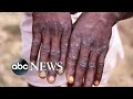What to know about monkeypox
