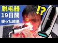 早くてハイパワー！回数制限の無い脱毛器【JOVS】