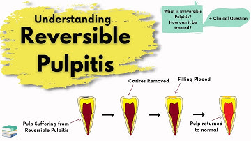 Reversible Pulpitis | Causes, Diagnosis and Treatment |  Endodontics