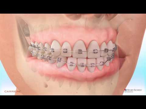 How Orthodontic Braces Work - Kyger Orthodontics BlogKyger Orthodontics Blog