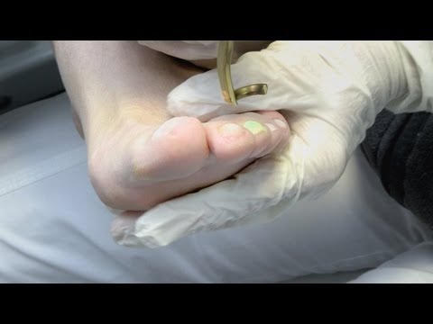 nagelpilz-ursache-und-behandlung---neu