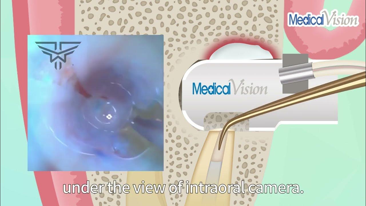 Hemostatic Endoscope Rootend Operation Solution YouTube