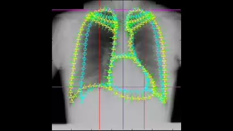 Active shape model used to segment lungs in chest radiographs