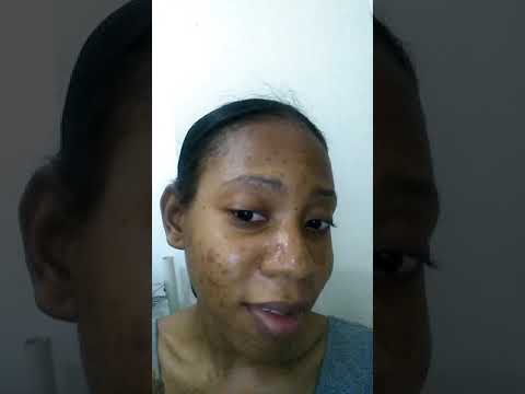 PAINFUL ACNE ON MY NOSE!!! CYSTIC ACNE!