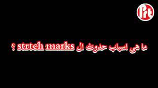 تعرفي علي معلومات حول ال Stretch Marks  ما هي وما أسباب ظهورها مع  د/ باسم محمد زكي