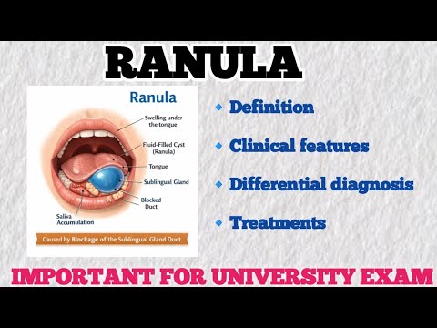 Ranula | Definition, Clinical Features, Differential Diagnosis ...