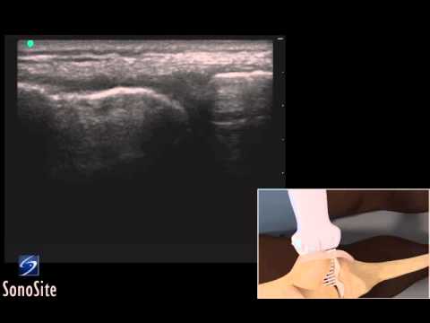 3D How to: Ultrasound Guided Injection of the Medial Collateral ...