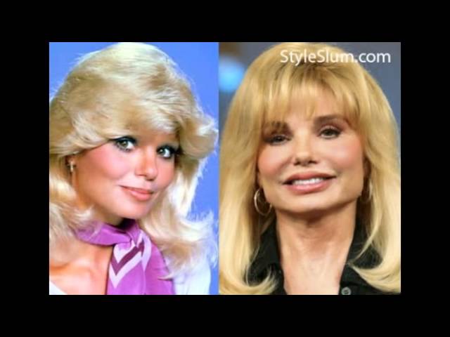 loni anderson plastic surgery Image 8