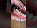 LIVE DEMO: MOST SIMPLE WAY TO DO POSTERIOR RESTORATION (PART 1)