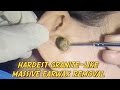 Hardest Granite-like Massive Earwax Removal