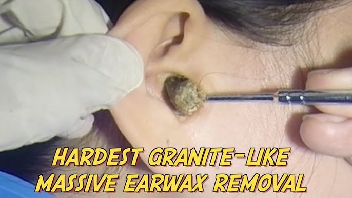 Hard & Massive Earwax Removal by Ear Irrigation 