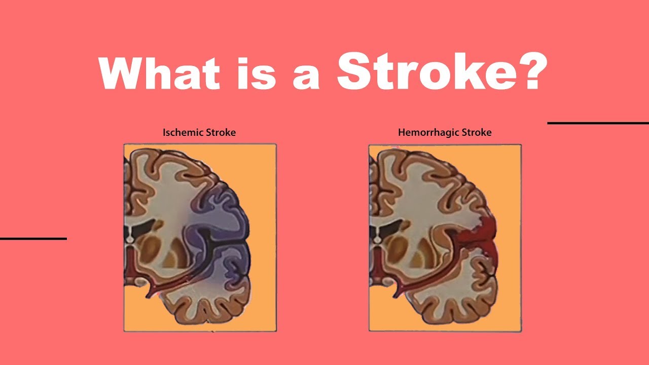 video phone beyonce mp3 What is a Stroke?