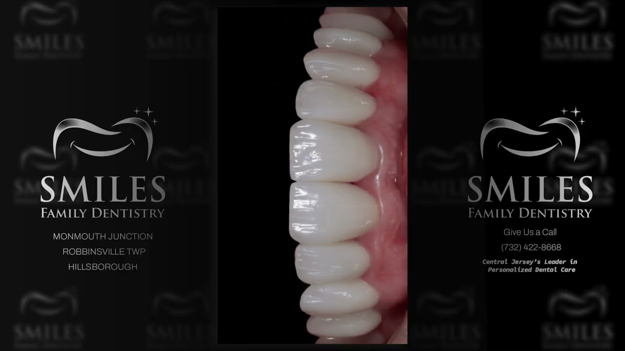 REVERSE BITE VENEERS