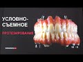 Условно-съемное протезирование