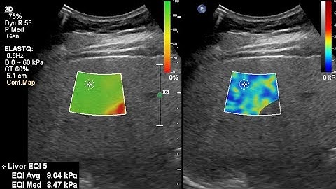 FibroScan, or elastography for liver stiffness, fibrosis, method, analysis