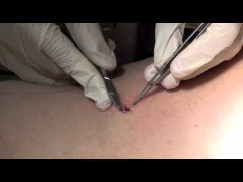 skin biopsies