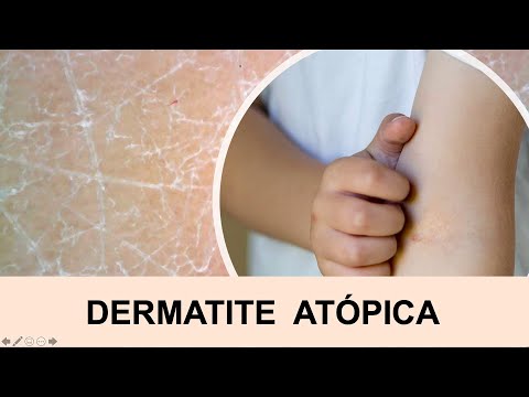 Vídeo: Linha De Pele De Eczema