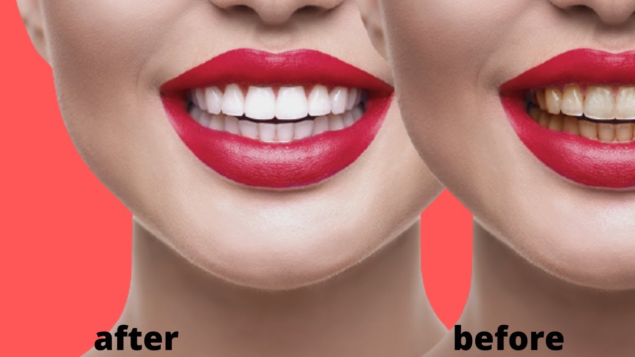 How To Get Teeth Whitening tips in Home Made YouTube