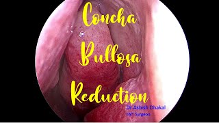 Concha Bullosa Reduction || Reduction of pneumatized middle turbinate