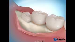 Murrieta Orthodontics third molar extraction soft tissue impaction screenshot 3