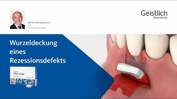 Wurzeldeckung eines Rezessionsdefekts