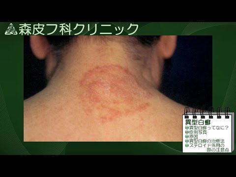 動画による皮膚病の解説　第14回　【異型白癬】