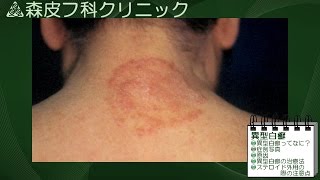 動画による皮膚病の解説　第14回　【異型白癬】