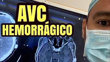 Quais as sequelas do AVC hemorrágico?