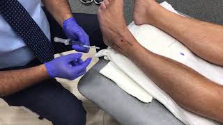 Ankle Steroid injection