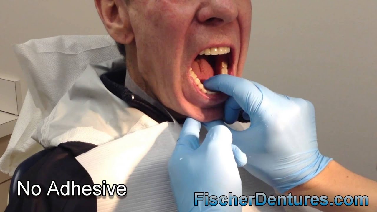 Lower Suction Dentures YouTube