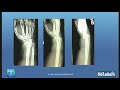 Distal radius fracture cases gone wrong - how to avoid and salvage problems