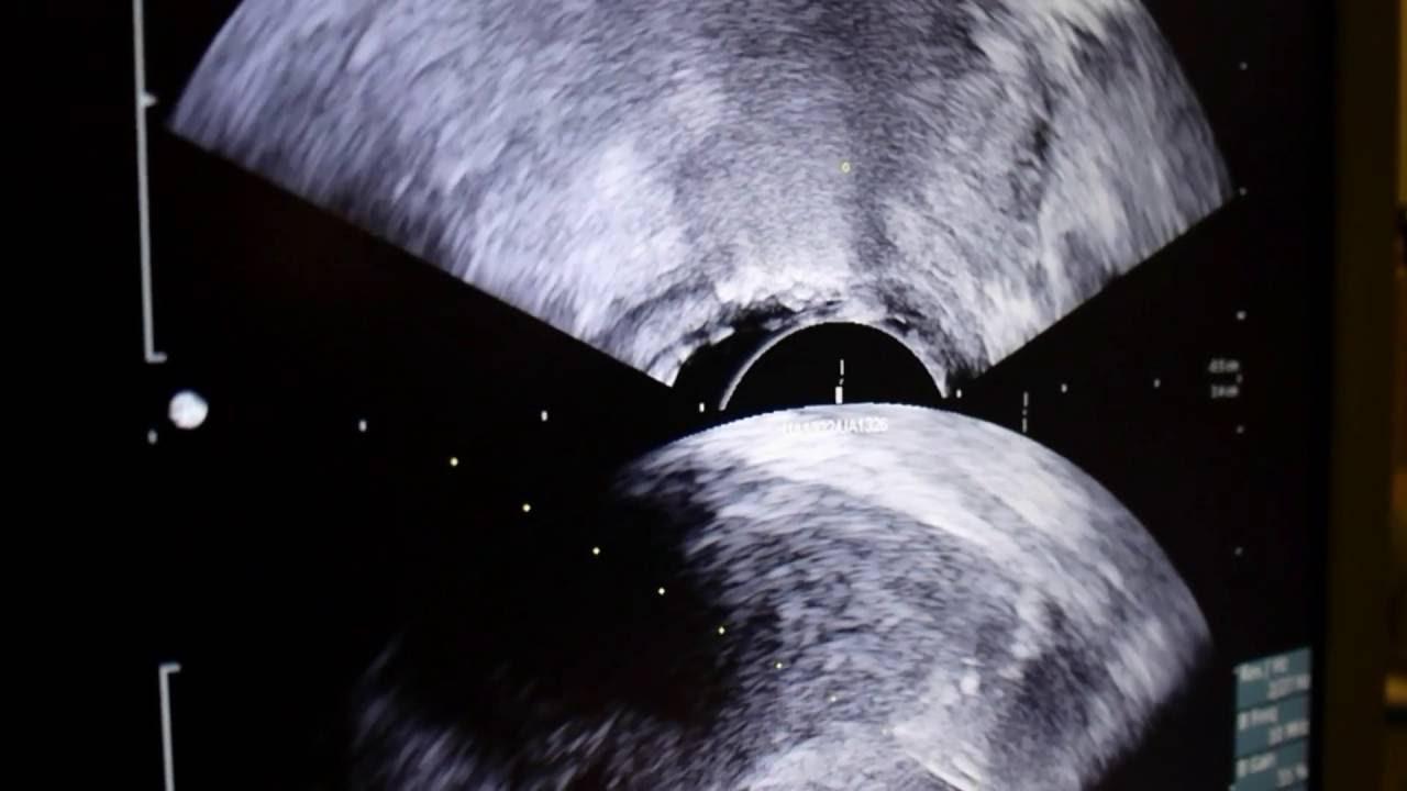 transrectal prostate biopsy infection