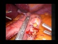 Laparoscopic sleeve gastrectomy-technical aspects