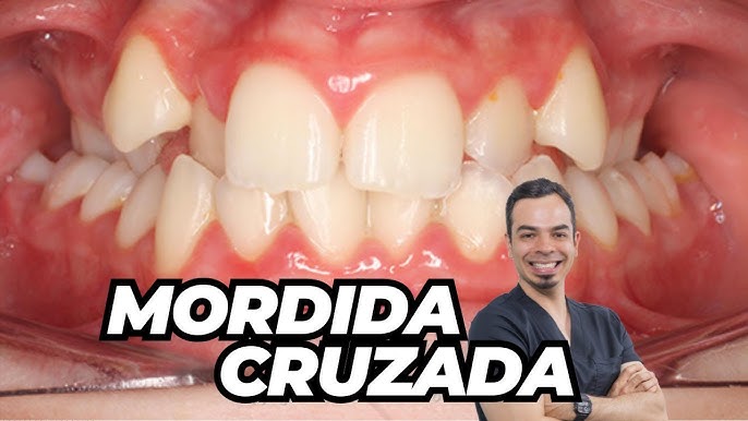 Estrategias para la correcta colocación de brackets protegiendo el arco de  sonrisa