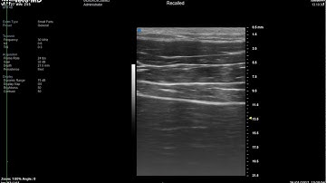 diaphragm sliding and thickening